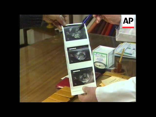 Moment image for Mandela Diagnosed with Prostate Cancer
